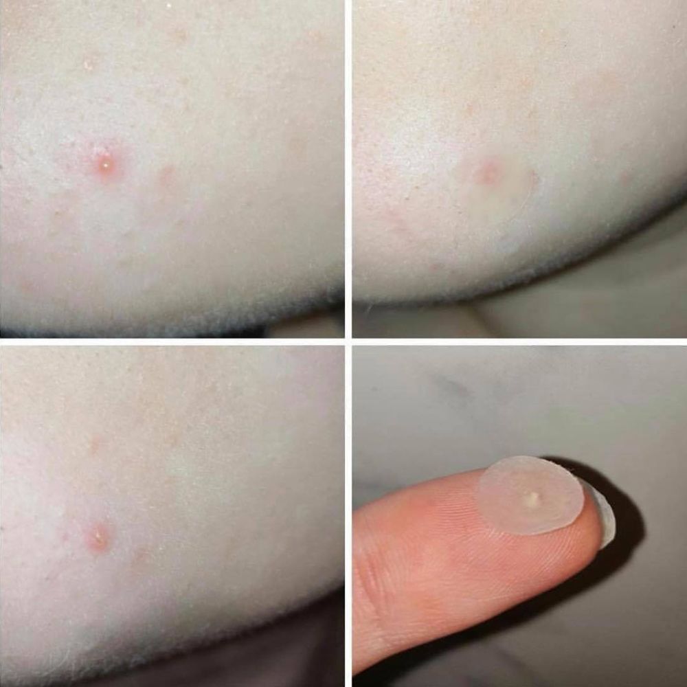 Jelly Ko Jelly Shield Pimple Patches 54 Patches 10mm each